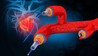Türkiye'de Anjiyo Fiyatları