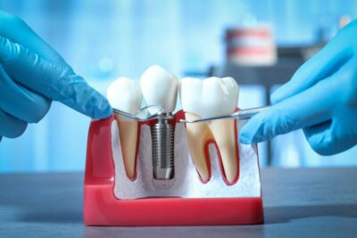 Türkiye’de dental implant tedavisi