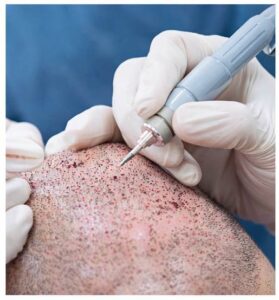 DHI saç ekimi tekniği