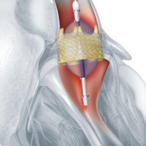 Kalp Kapak Ameliyatı Maliyetleri