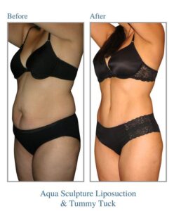 Karın Germe Türkiye