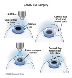 Цены на LASIK в Турции