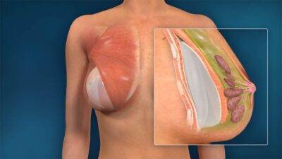 Meme Büyütme Fiyatları