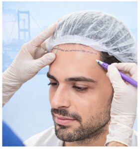 Türkiye’de saç ekimi