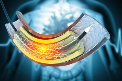 Türkiye'de Stent Tedavisi Maliyetleri