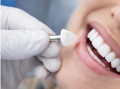 Türkiye Hollywood Smile Fiyat