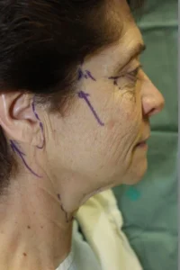 Yüz Germe Ameliyatı