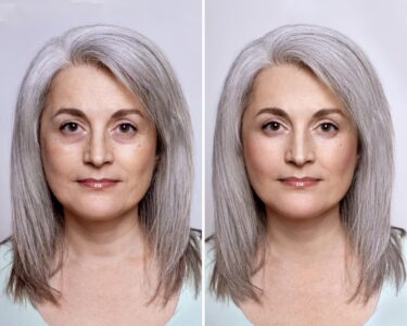 Yüz Germe Fiyatlarını