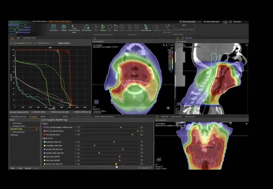 CyberKnife ile Ameliyatsız Kanser Tedavisi: Türkiye'de Robotik Cerrahinin Yeni Çağı