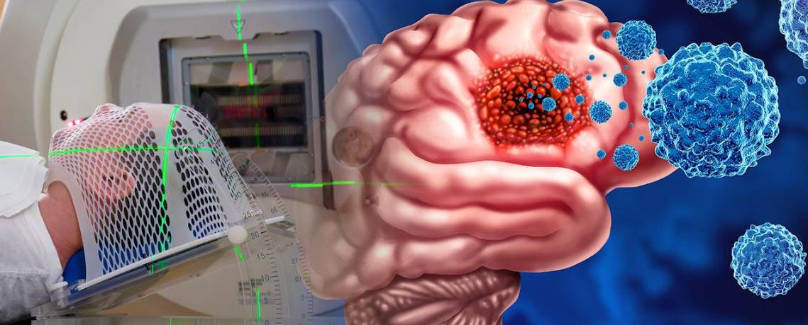 Gama Knife Teknolojisi: Türkiye'de Ameliyatsız Beyin Tümörü Tedavisinde Çığır Açan İnovasyon