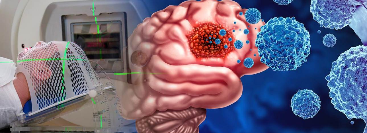 Ameliyatsız Beyin Tümörü Tedavisi Türkiye